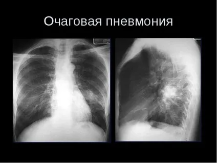Пневмонія на рентгенівських знімках (ознаки включають себе) Пневмонія на рентгенівських знімках