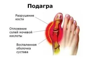 Подагрична нирка - хронічна форма ниркової недостатності (форма) Подагрична нирка - хронічна форма ниркової недостатності