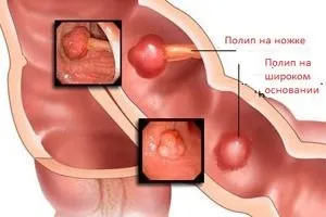 Поліпозно риносинусит, прояв і лікування (лікування) Поліпозно риносинусит, прояв і лікування