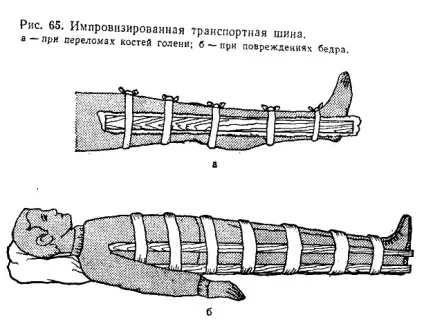 Портная іммобілізація матеріальне забезпечення (накладають задній поверхні) Портная іммобілізація матеріальне забезпечення