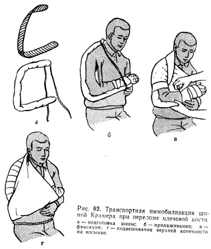Портная іммобілізація матеріальне забезпечення (портная) Портная іммобілізація матеріальне забезпечення