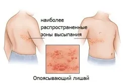 Поперековий герпес симптоми, причини, лікування (фото і відео) (перший по герпесу) Поперековий герпес симптоми, причини, лікування (фото і відео)