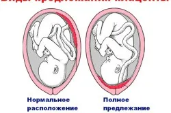 Причини кров'яних виділень у жінок (причини) Причини кров'яних виділень у жінок