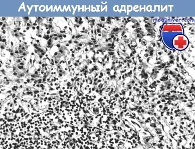 Причини і механізми розвитку первинної хронічної недостатності надниркових залоз