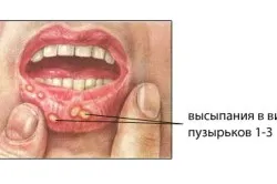 Прозорі бульбашки в роті