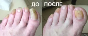 протезування нігтів