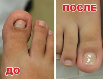 протезування нігтів