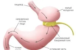 розтягнутий шлунок