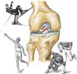 Розрив передньої хрестоподібної зв'язки симптоми, лікування, методи діагностики (розрив пошкодження передньої хрестоподібної зв'язки коліна суглоб лікування) Розрив передньої хрестоподібної зв'язки симптоми, лікування, методи діагностики