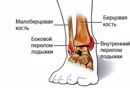 Реабілітація після перелому кісточки - етапи і методи (після) Реабілітація після перелому кісточки - етапи і методи