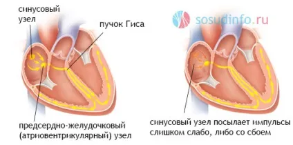 Са-блокада, синоатріальна, синоаурикулярная ступеня і типи, лікування (синоаурикулярная) Са-блокада, синоатріальна, синоаурикулярная ступеня і типи, лікування