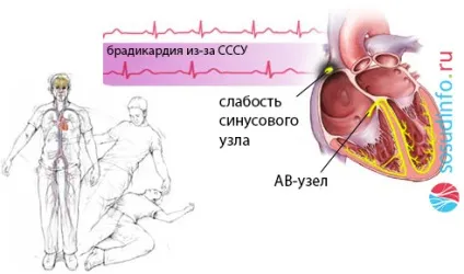 Са-блокада, синоатріальна, синоаурикулярная ступеня і типи, лікування (синоатріальна) Са-блокада, синоатріальна, синоаурикулярная ступеня і типи, лікування