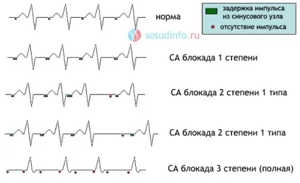 Са-блокада, синоатріальна, синоаурикулярная ступеня і типи, лікування (ступеня) Са-блокада, синоатріальна, синоаурикулярная ступеня і типи, лікування
