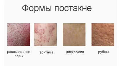 Засоби від постакне і рубців кращі і ефективніші (кошти) Засоби від постакне і рубців кращі і ефективніші