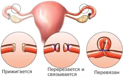 Стерилізація як метод контрацепції (наслідки) Стерилізація як метод контрацепції
