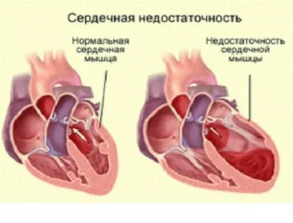 стадії ХСН