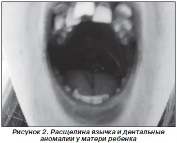Секвенция П'єра Робена