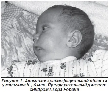 Секвенция П'єра Робена