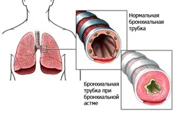 Симптоми і ознаки астми