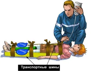 Синдром тривалого здавлення - клінічна картина, перша допомога та лікування (клінічна) Синдром тривалого здавлення - клінічна картина, перша допомога та лікування