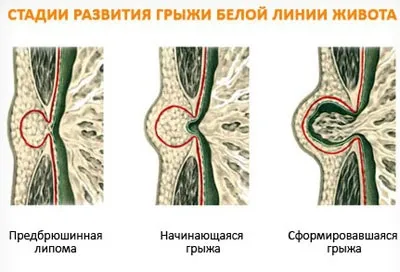 Симптоми грижі на животі