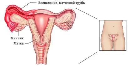 Симптоми запалення яєчників і їх придатків у жінок (запалення) Симптоми запалення яєчників і їх придатків у жінок