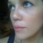 Скільки тримається набряк носа після ринопластики фото і відгуки