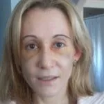 Скільки тримається набряк носа після ринопластики фото і відгуки
