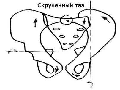 Синдром косого і скрученого тазу, altmed (косого) Синдром косого і скрученого тазу, altmed