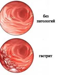 Змішаний гастрит причини, симптоми, лікування і дієта (змішаний гастрит причини класифікація симптоми діагностика лікування профілактика препарати дієта) Змішаний гастрит причини, симптоми, лікування і дієта