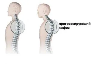Спонділодісплазія причини, методи терапії і профілактика (причини) Спонділодісплазія причини, методи терапії і профілактика