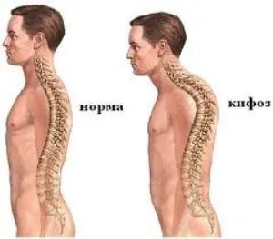 Спонділодісплазія - що це за хвороба (спонділодісплазія) Спонділодісплазія - що це за хвороба