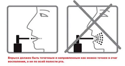 Спрей при ангіні огляд ефективних препаратів (ангіні) Спрей при ангіні огляд ефективних препаратів