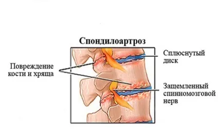 Спондилоартроз грудного відділу хребта лікування, симптоми, причини (грудного) Спондилоартроз грудного відділу хребта лікування, симптоми, причини