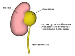 Стриктура сечоводу причини виникнення, симптоми і способи лікування