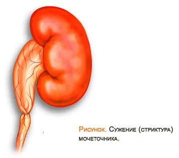 Стриктура сечоводу, клініка урології першого МГМУ їм (сечоводу) Стриктура сечоводу, клініка урології першого МГМУ їм