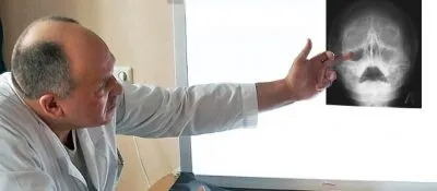 Субтотальне затемнення гайморових пазух що це таке, причини виникнення та терапевтичні (затемнення) Субтотальне затемнення гайморових пазух що це таке, причини виникнення та терапевтичні