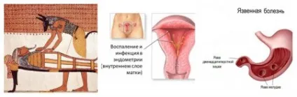 Столітник в гінекологи
