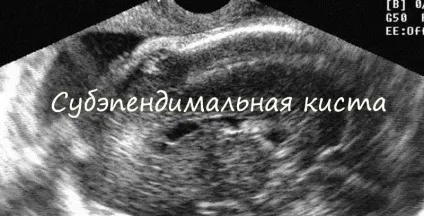Субепендімальная кіста у новонародженої дитини, її ознаки, лікування, наслідки (дитини) Субепендімальная кіста у новонародженої дитини, її ознаки, лікування, наслідки