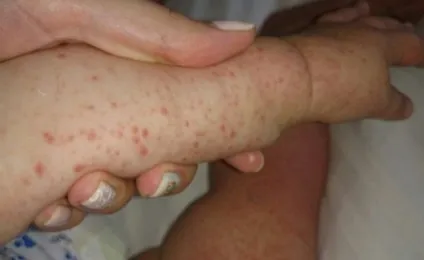 Страшний вірус для дітей і дорослих можна підхопити на відпочинку в Туреччині (підхопити) Страшний вірус для дітей і дорослих можна підхопити на відпочинку в Туреччині