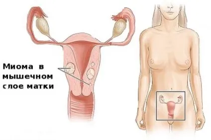 Столітник в гінекологи