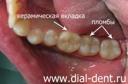 Своєчасна діагностика карієсу по панорамному знімку (лікування каналів зуба мікроскопом) Своєчасна діагностика карієсу по панорамному знімку