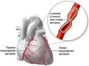 Тахікардія при стенокардії лікування, чим відрізняється, симптоми (тахікардія) Тахікардія при стенокардії лікування, чим відрізняється, симптоми
