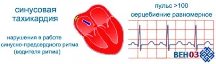Тахікардія серця що це таке, стенокардія, брадикардія (симптоми) (серця) Тахікардія серця що це таке, стенокардія, брадикардія (симптоми)