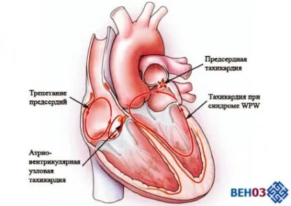 Тахікардія серця що це таке, стенокардія, брадикардія (симптоми) (таке) Тахікардія серця що це таке, стенокардія, брадикардія (симптоми)