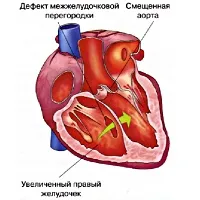 Тетрада фалло - причини, симптоми, діагностика та лікування