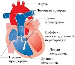 Тетрада фалло - причини, симптоми, лікування, прогноз (тетрада фалло) Тетрада фалло - причини, симптоми, лікування, прогноз
