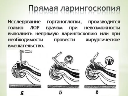 Техніка прямої і непрямої ларингоскопії гортані відео, свідчення, методи (техніка) Техніка прямої і непрямої ларингоскопії гортані відео, свідчення, методи