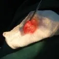 Видалення поліпів у носі лазером ціна, відгуки, відео (носі) Видалення поліпів у носі лазером ціна, відгуки, відео