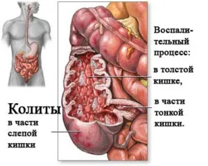 Важкість у животі і здуття (здуття) Важкість у животі і здуття